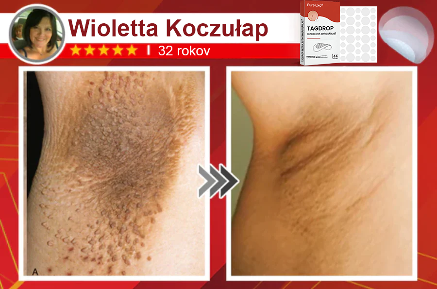 🌈Pureluxo® Náplasť na odstránenie kožných výrastkov s mikroihličkami