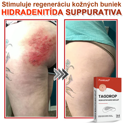 🌈Pureluxo® Náplasť na odstránenie kožných výrastkov s mikroihličkami