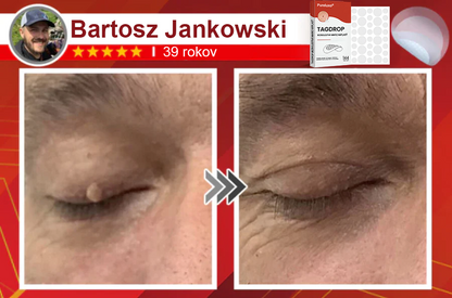 🌈Pureluxo® Náplasť na odstránenie kožných výrastkov s mikroihličkami