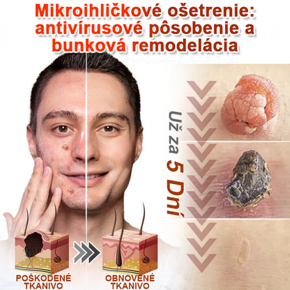 🌈Pureluxo® Náplasť na odstránenie kožných výrastkov s mikroihličkami