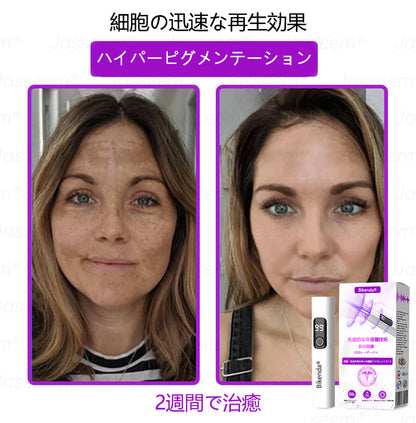 Bikenda® 高性能CO₂レーザーペン 🛫（痛みなし・面倒なしで、イボ・ほくろ・シミ・小さな肌のふくらみをやさしく除去！）お肌のケアにおすすめの非侵襲的アイテムだよ！