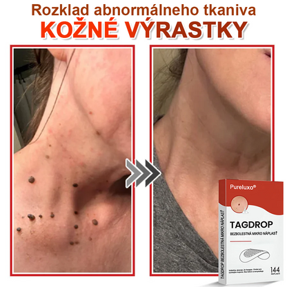🌈Pureluxo® Náplasť na odstránenie kožných výrastkov s mikroihličkami