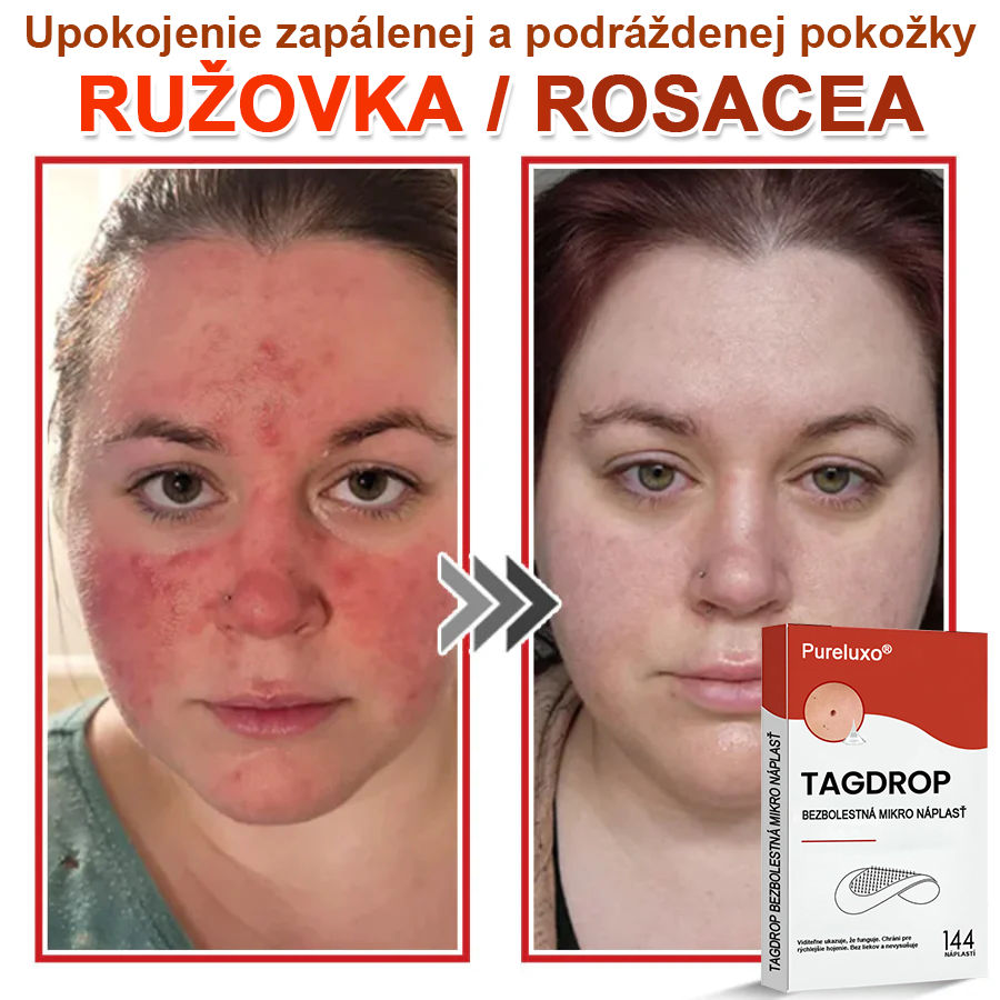 🌈Pureluxo® Náplasť na odstránenie kožných výrastkov s mikroihličkami