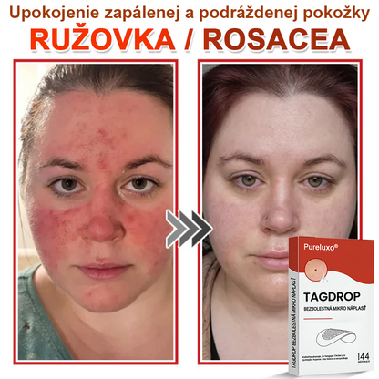 🌈Pureluxo® Náplasť na odstránenie kožných výrastkov s mikroihličkami
