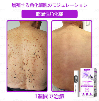 Bikenda® 高性能CO₂レーザーペン 🛫（痛みなし・面倒なしで、イボ・ほくろ・シミ・小さな肌のふくらみをやさしく除去！）お肌のケアにおすすめの非侵襲的アイテムだよ！